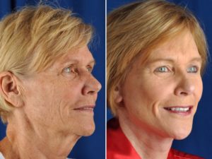 Before and after of a facelift in Dallas