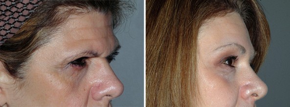 patient before and after a browlift