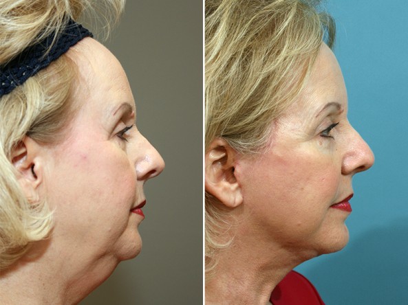 Before and After Photo of Facelift