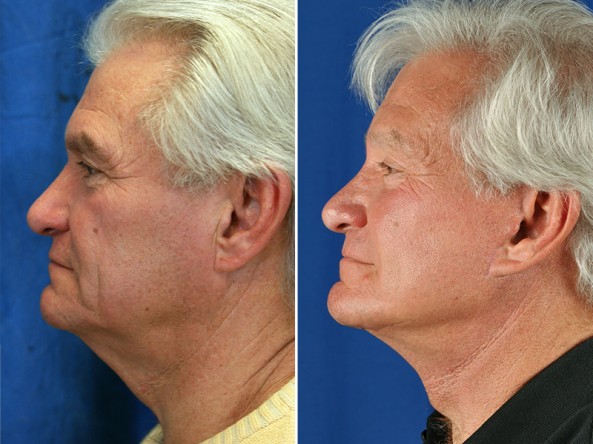 patient before and after a facelift