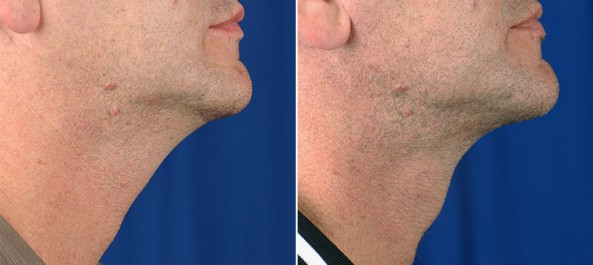 patient before and after neck lift