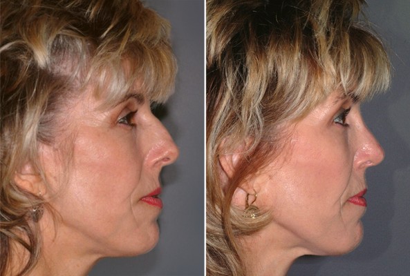 patient before and after a rhinoplasty