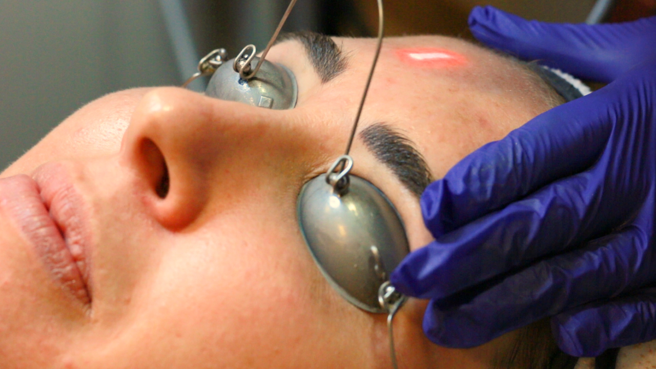 laser on patient's forehead with protective eyewear