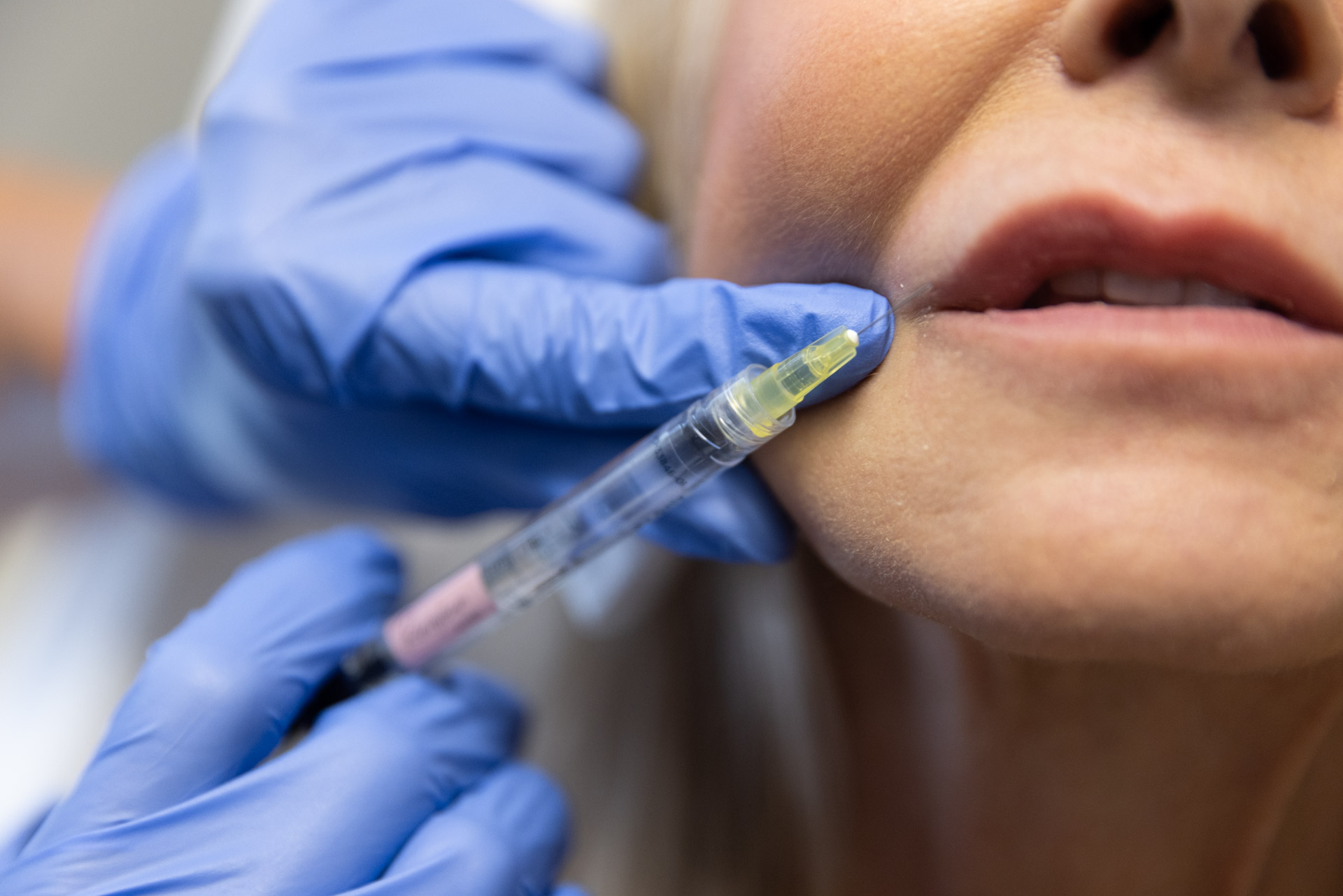 up close of woman being injected with facial fillers