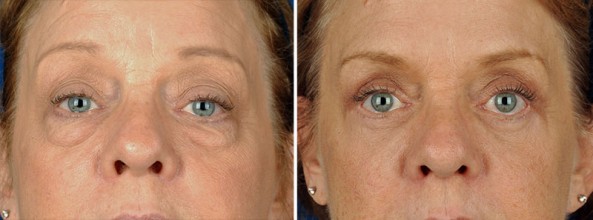 Puffy Eyes and Bags with Eyelid Surgery