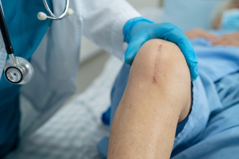 Close up of a scar on a person's knee