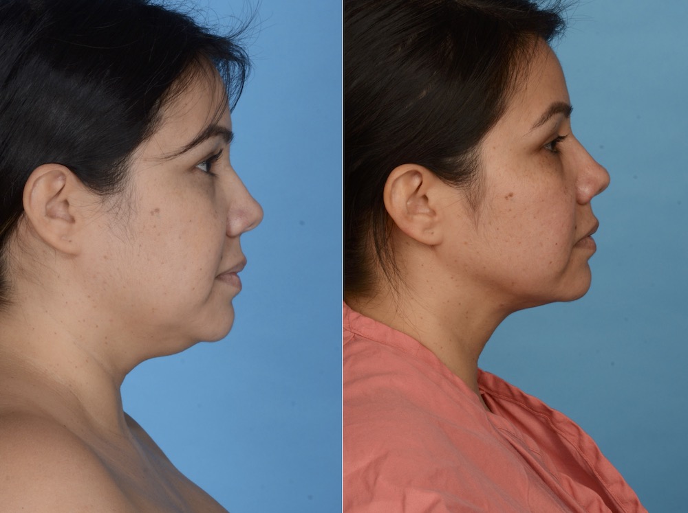 A woman's side profile before and after Double Chin Liposuction near Fort Worth.