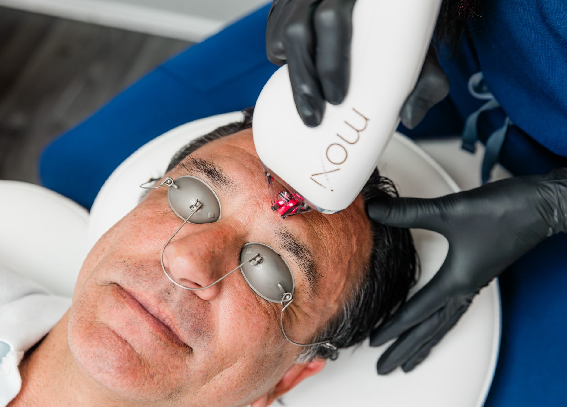 Close up of a melasma treatment near Grapevine, TX, on a male patient at Southlake Plastic Surgery & Med Spa.