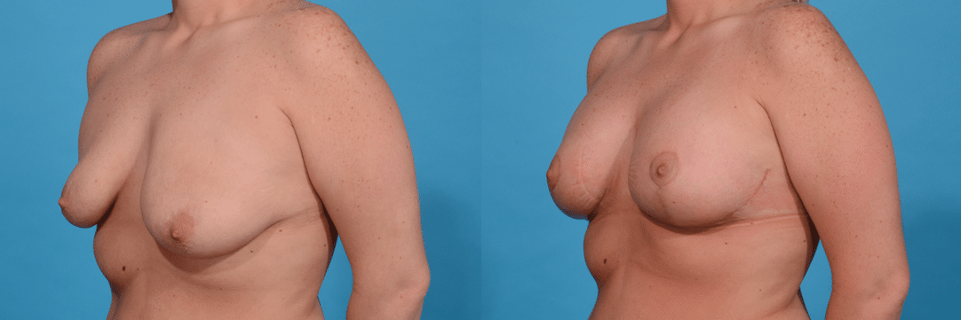 Before and After Image: Breast Augmentation - left-front-oblique