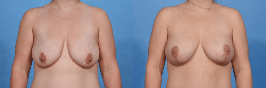 Before and After Image: Breast Augmentation - front