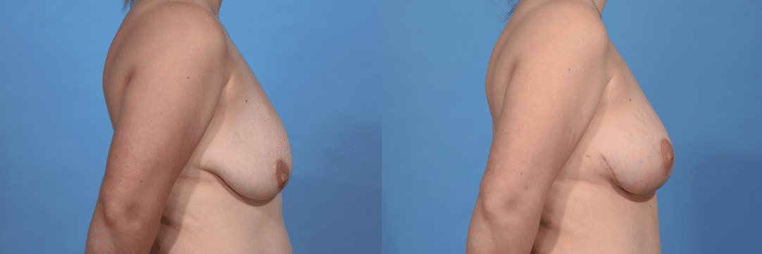 Before and After Image: Breast Augmentation - right-side