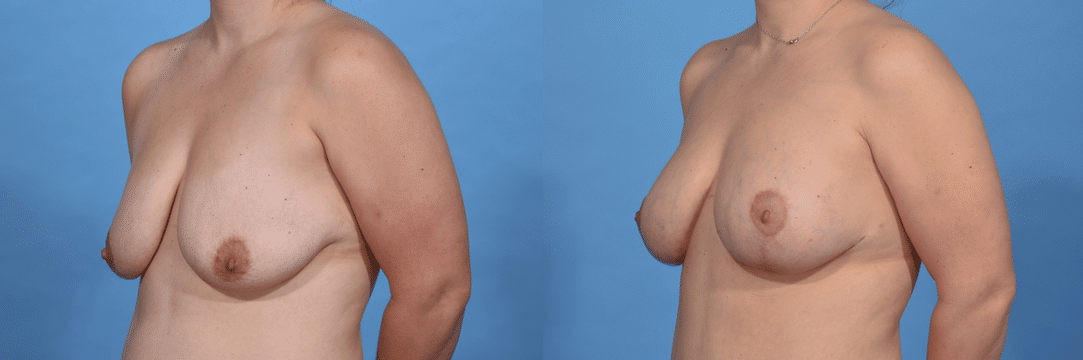 Before and After Image: Breast Augmentation - left-front-oblique