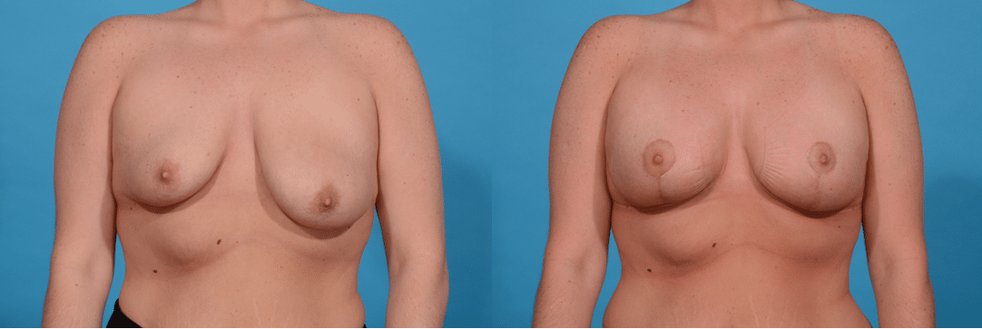 Before and After Image: Breast Augmentation - front