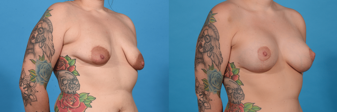 Before and After Image: Breast Augmentation - right-front-oblique