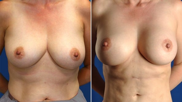 Before and After Image: Breast Augmentation - front