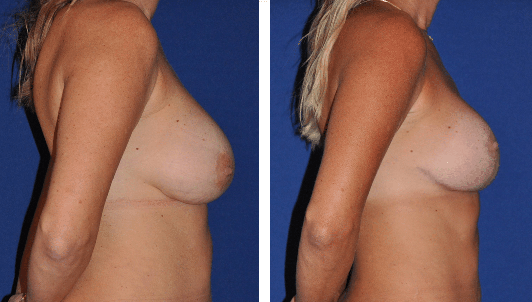 Before and After Image: Breast Augmentation with Lift - right-side