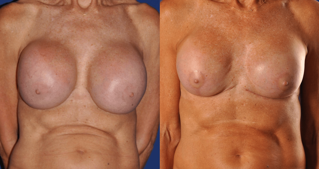 Before and After Image: Breast Augmentation with Lift - front