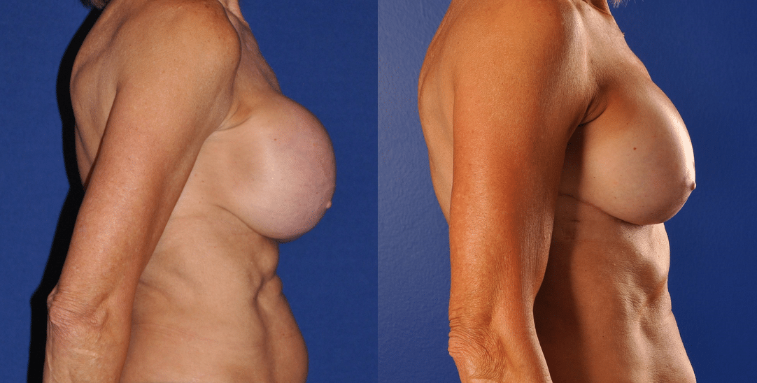 Before and After Image: Breast Augmentation with Lift - right-side