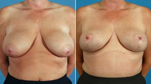 Before and After Image: Breast Lift - front