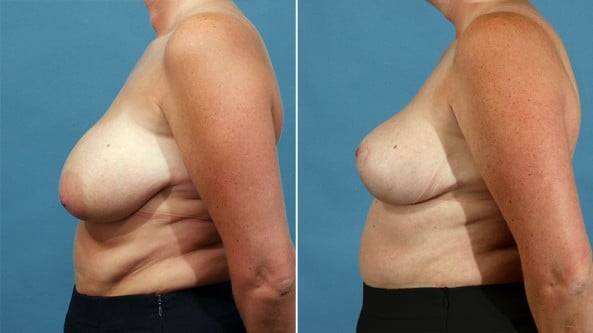 Before and After Image: Breast Lift - left-side