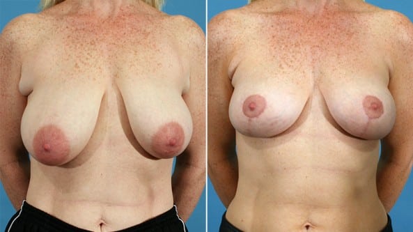 Before and After Image: Breast Lift - front