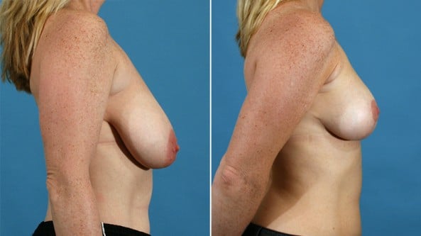 Before and After Image: Breast Lift - right-side