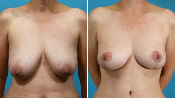 Before and After Image: Breast Lift - front