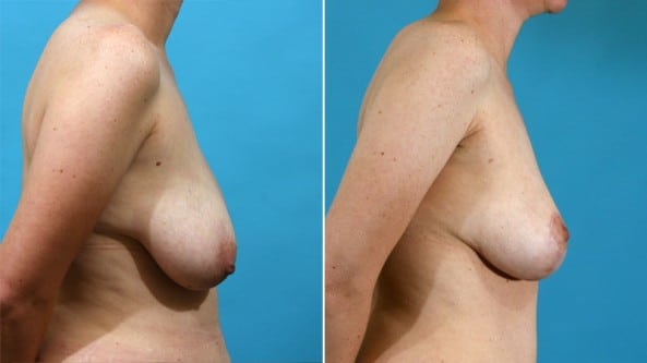 Before and After Image: Breast Lift - right-side