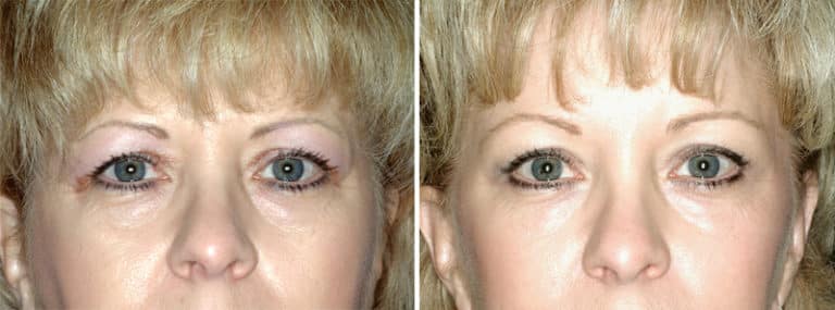 Before and After Image: Brow Lift - front