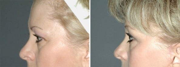 Before and After Image: Brow Lift - left-side