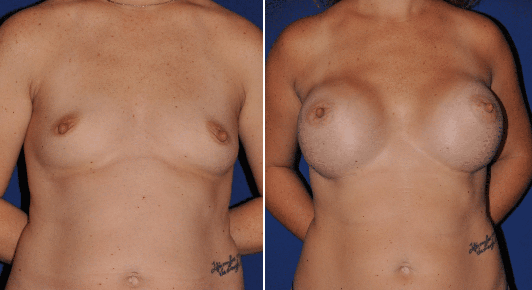 Before and After Image: Breast Augmentation - front
