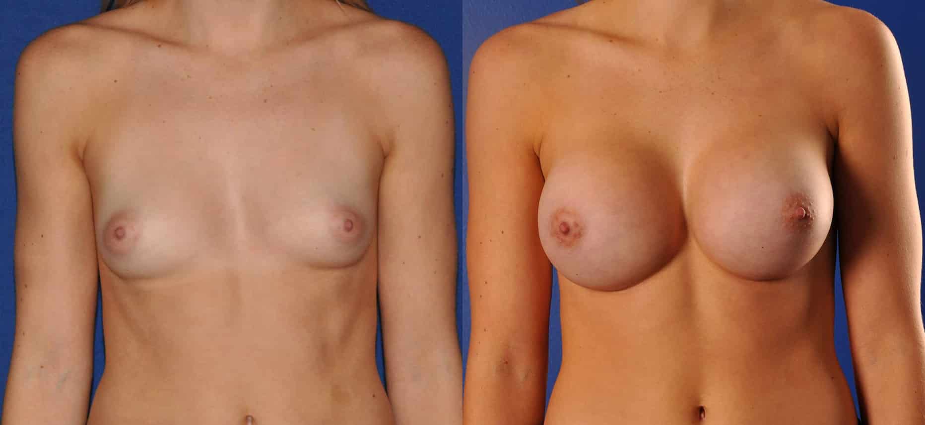 Before and After Image: Breast Augmentation - front