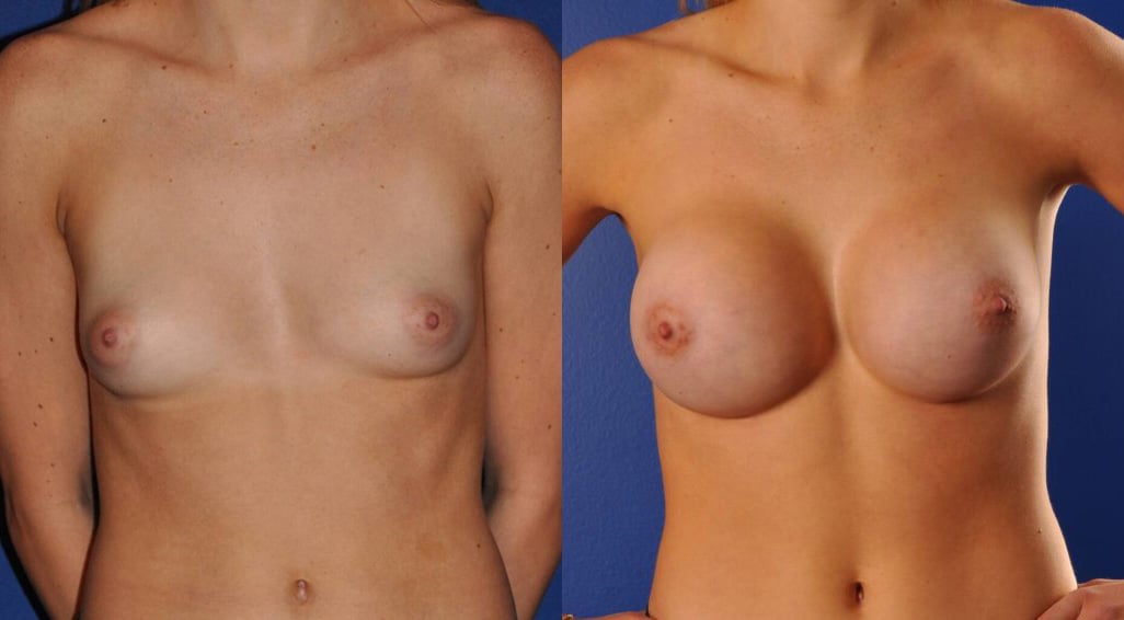 Before and After Image: Breast Augmentation - front