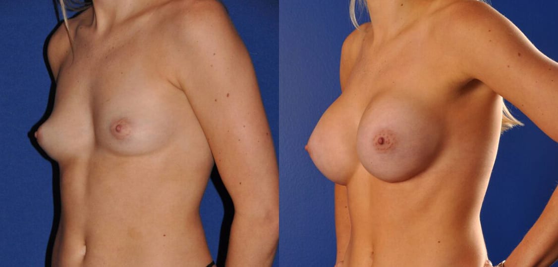 Before and After Image: Breast Augmentation - left-front-oblique
