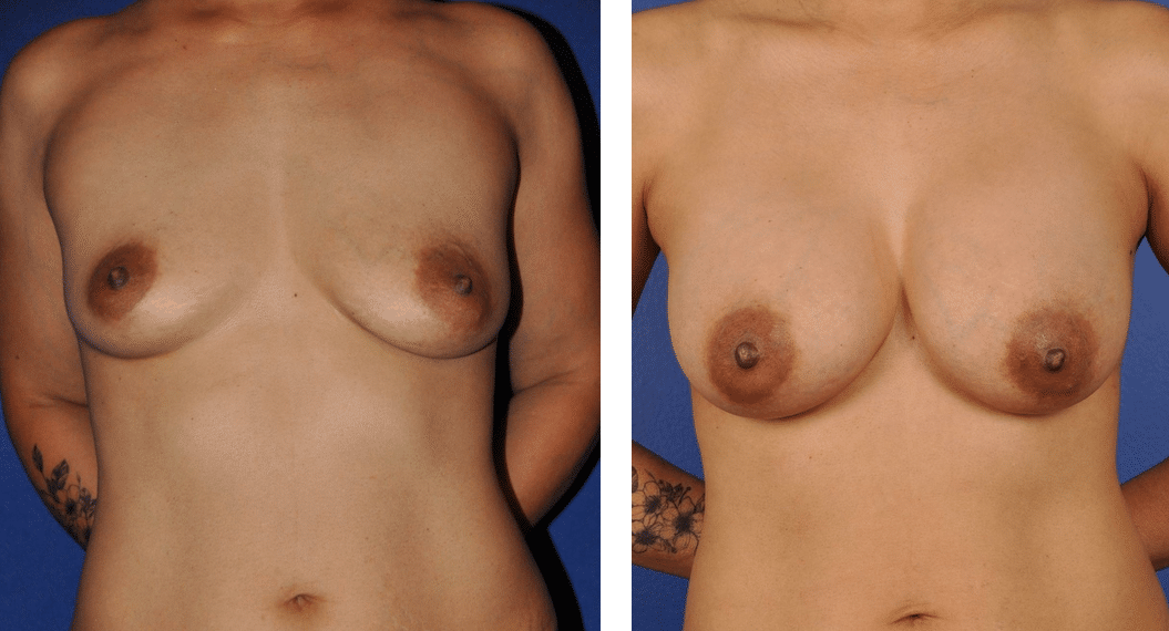 Before and After Image: Breast Augmentation - front