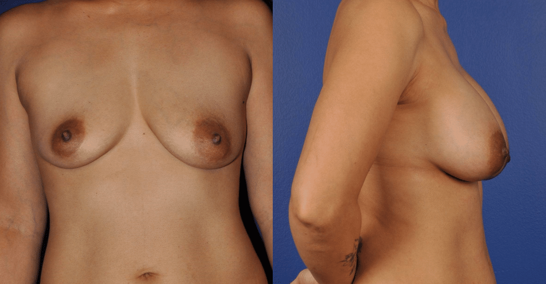 Before and After Image: Breast Augmentation - front