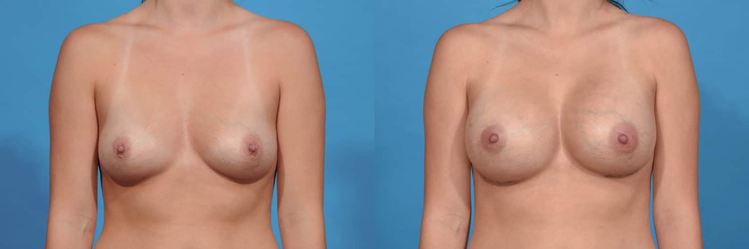 Before and After Image: Breast Augmentation - front