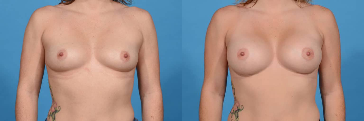 Before and After Image: Breast Augmentation - front