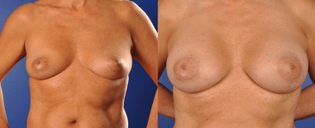 Before and After Image: Breast Augmentation - front