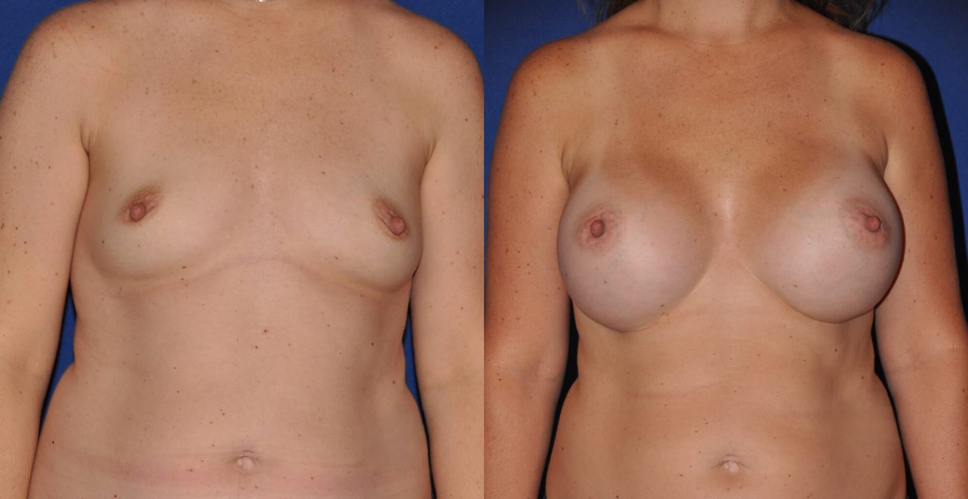 Before and After Image: Breast Augmentation - front