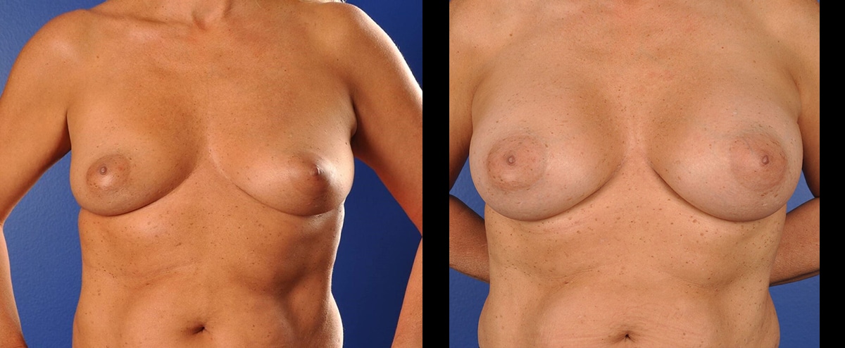Before and After Image: Breast Augmentation - front