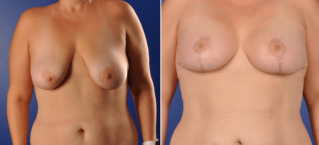 Before and After Image: Breast Augmentation with Lift - front