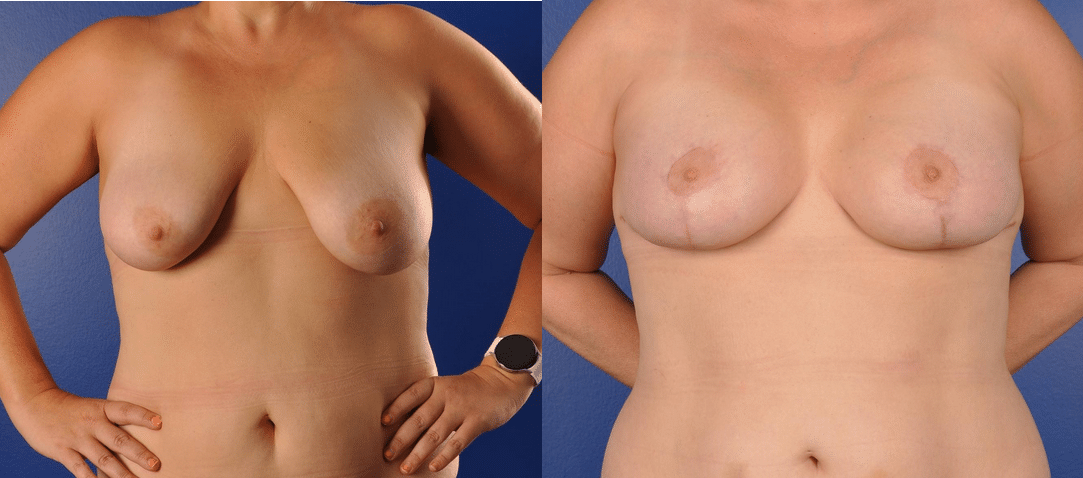 Before and After Image: Breast Augmentation with Lift - front