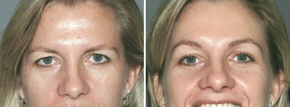 Before and After Image: Brow Lift - front