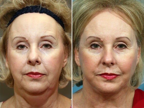 Before and After Image: Chin Implant - front