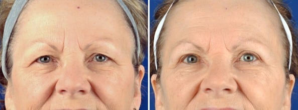 Before and After Image: Eyelid Surgery - front