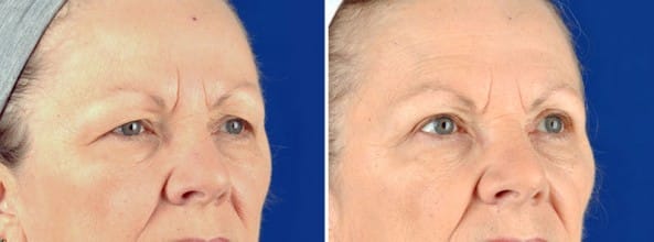Before and After Image: Eyelid Surgery - right-front-oblique