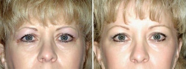 Before and After Image: Eyelid Surgery - front
