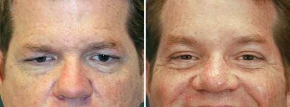 Before and After Image: Eyelid Surgery - front