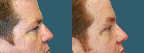 Before and After Image: Eyelid Surgery - right-side